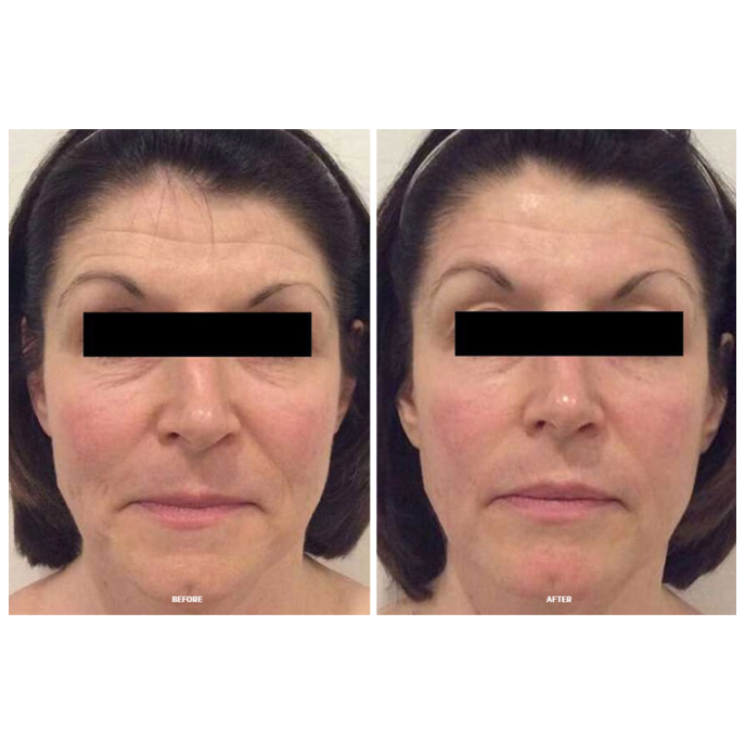 Calecim Professional Serum 5ml (2 шт)