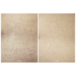 Calecim Professional Serum 5ml (2 vnt.)