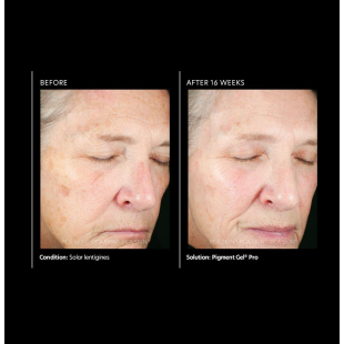 PCA Skin Pigment Gel Pro 29ml