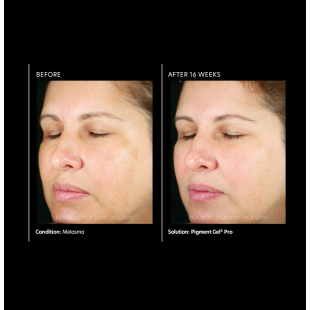 PCA Skin Pigment Gel Pro 29ml