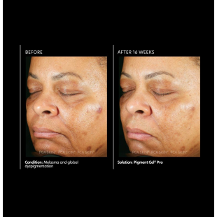 PCA Skin Pigment Gel Pro 29ml